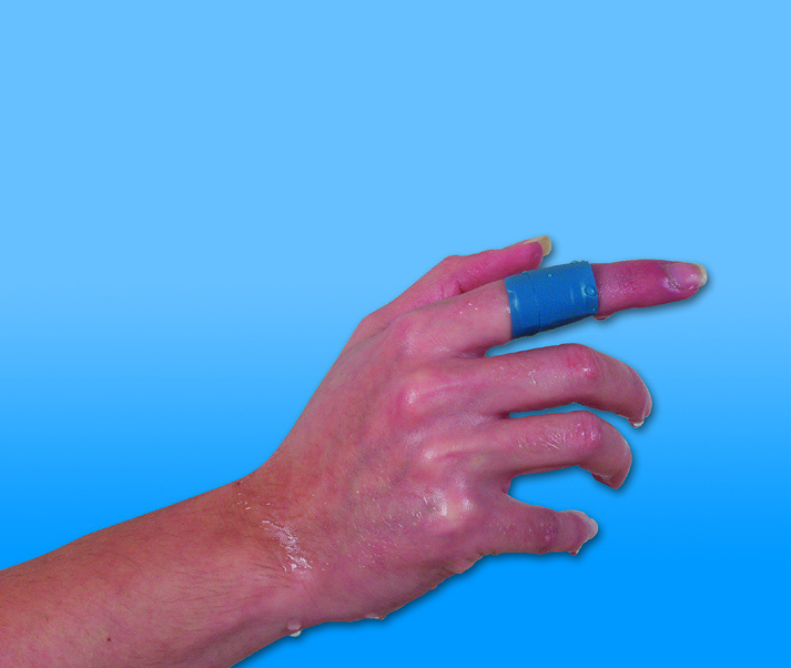 040212:RUDADETEC Fingerkuppenpflaster, Pflaster