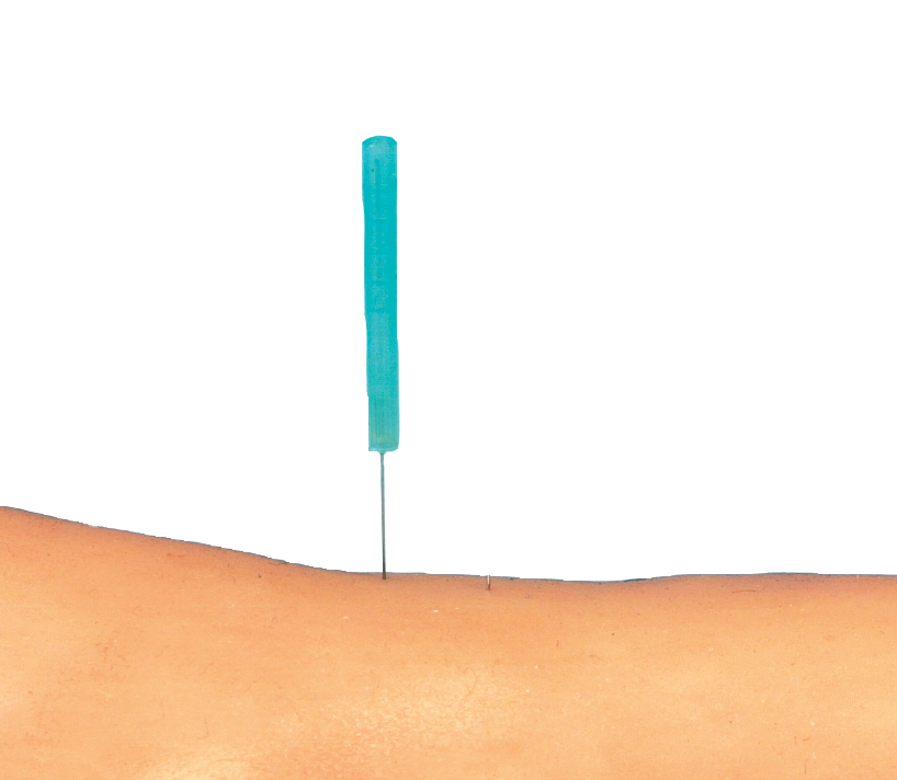 S8KS2525:DONGBANG –  Akupunkturnadeln mit Kunststoffgriff