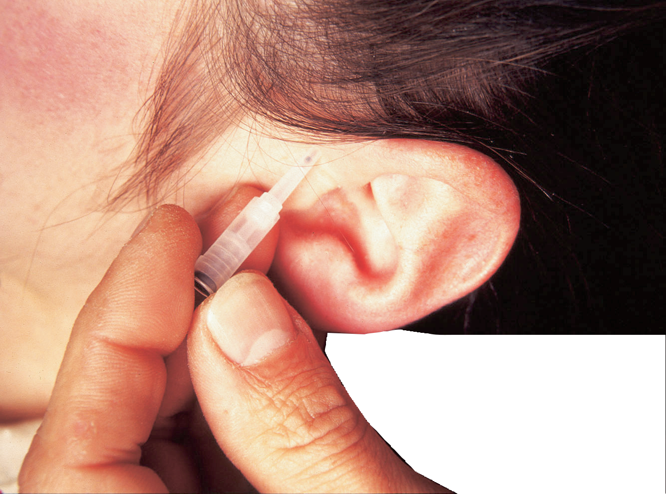 ASP Ohrakupunkturnadel